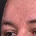 Lipoma surgery bump forehead Atlanta