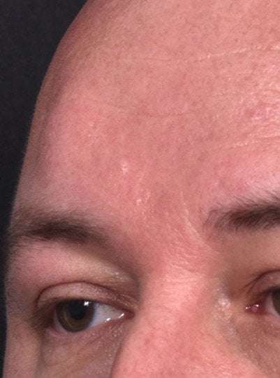 Lipoma surgery bump forehead Atlanta