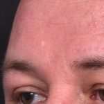 Lipoma surgery bump forehead Atlanta