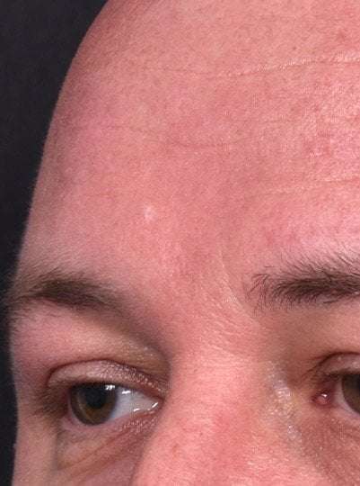 Lipoma surgery bump forehead Atlanta