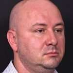 Lipoma forehead bump surgery Atlanta