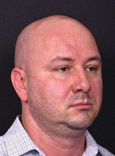 Lipoma forehead bump surgery Atlanta