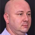 Lipoma forehead bump surgery Atlanta