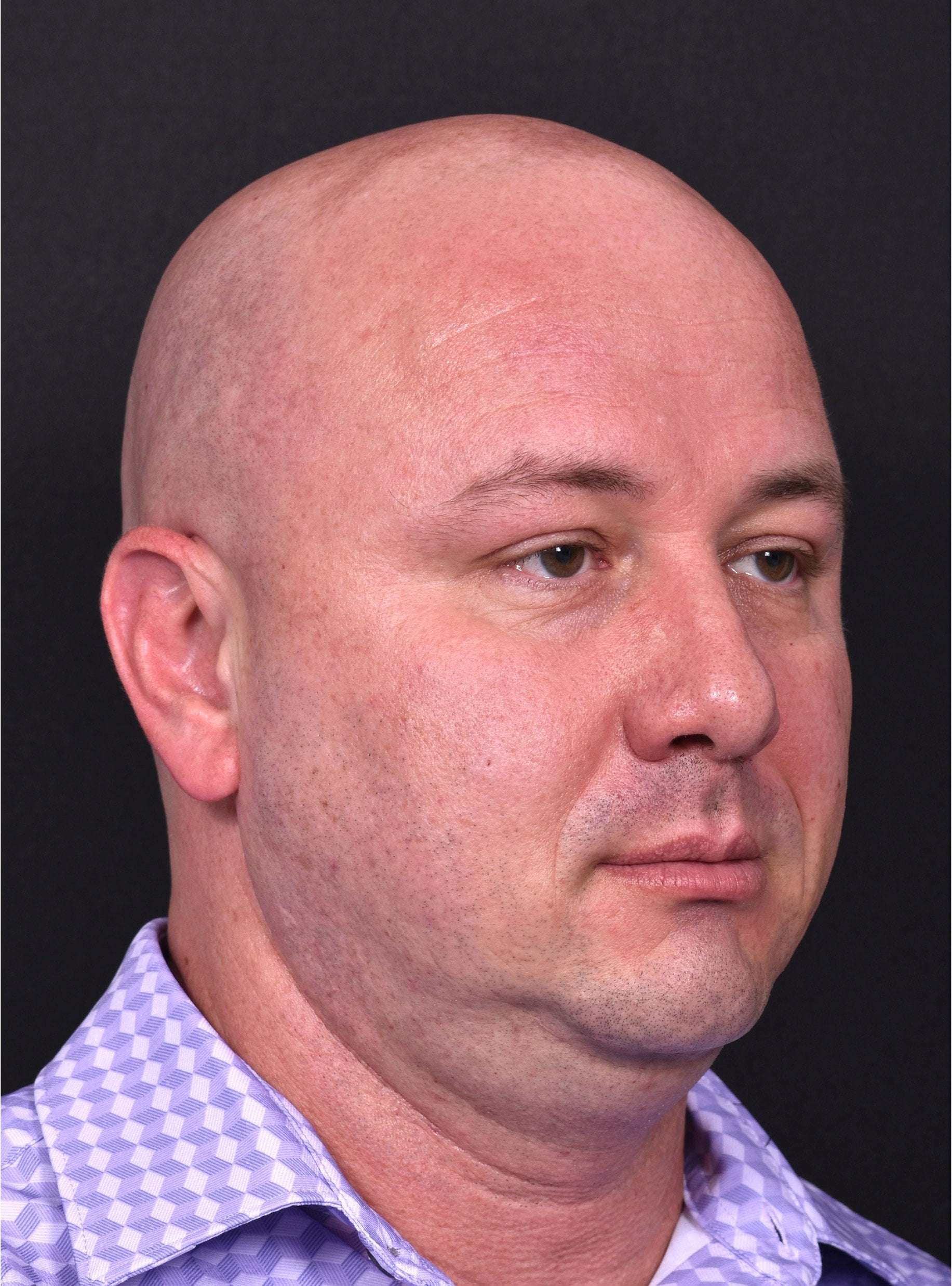 Lipoma forehead bump surgery Atlanta