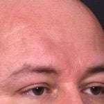 Lipoma surgery bump forehead Atlanta