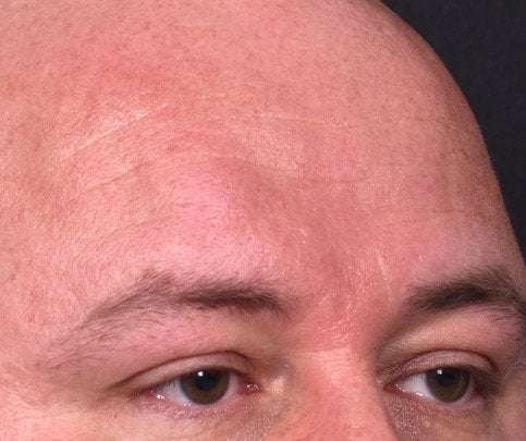 Lipoma surgery bump forehead Atlanta
