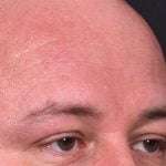 Lipoma surgery bump forehead Atlanta