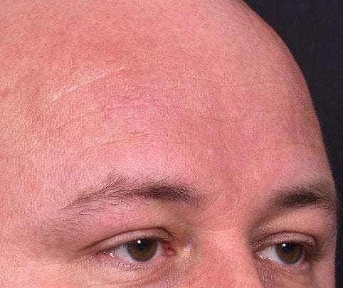 Lipoma surgery bump forehead Atlanta