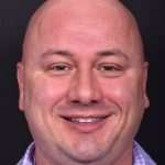 Lipoma forehead bump soft