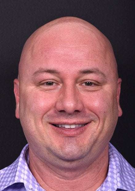 Lipoma forehead bump soft