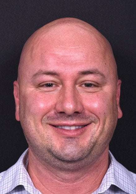 Lipoma forehead bump soft