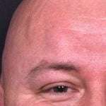 Lipoma forehead bump soft