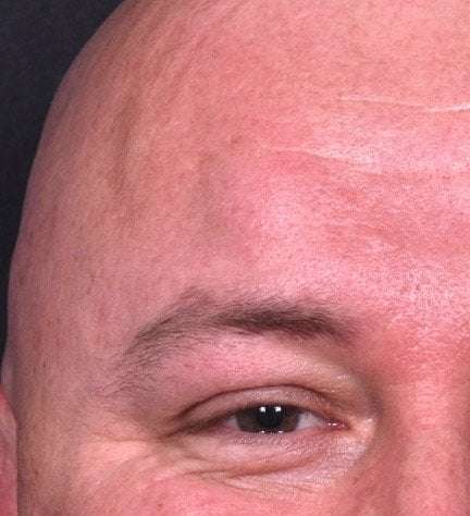 Lipoma forehead bump soft