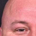 Lipoma forehead bump soft