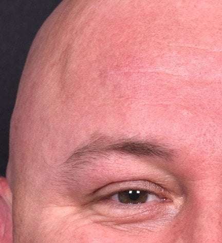 Lipoma forehead bump soft