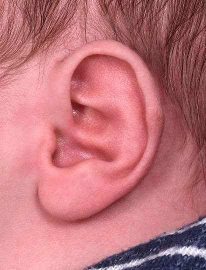 Earwell newborn ear correction Atlanta