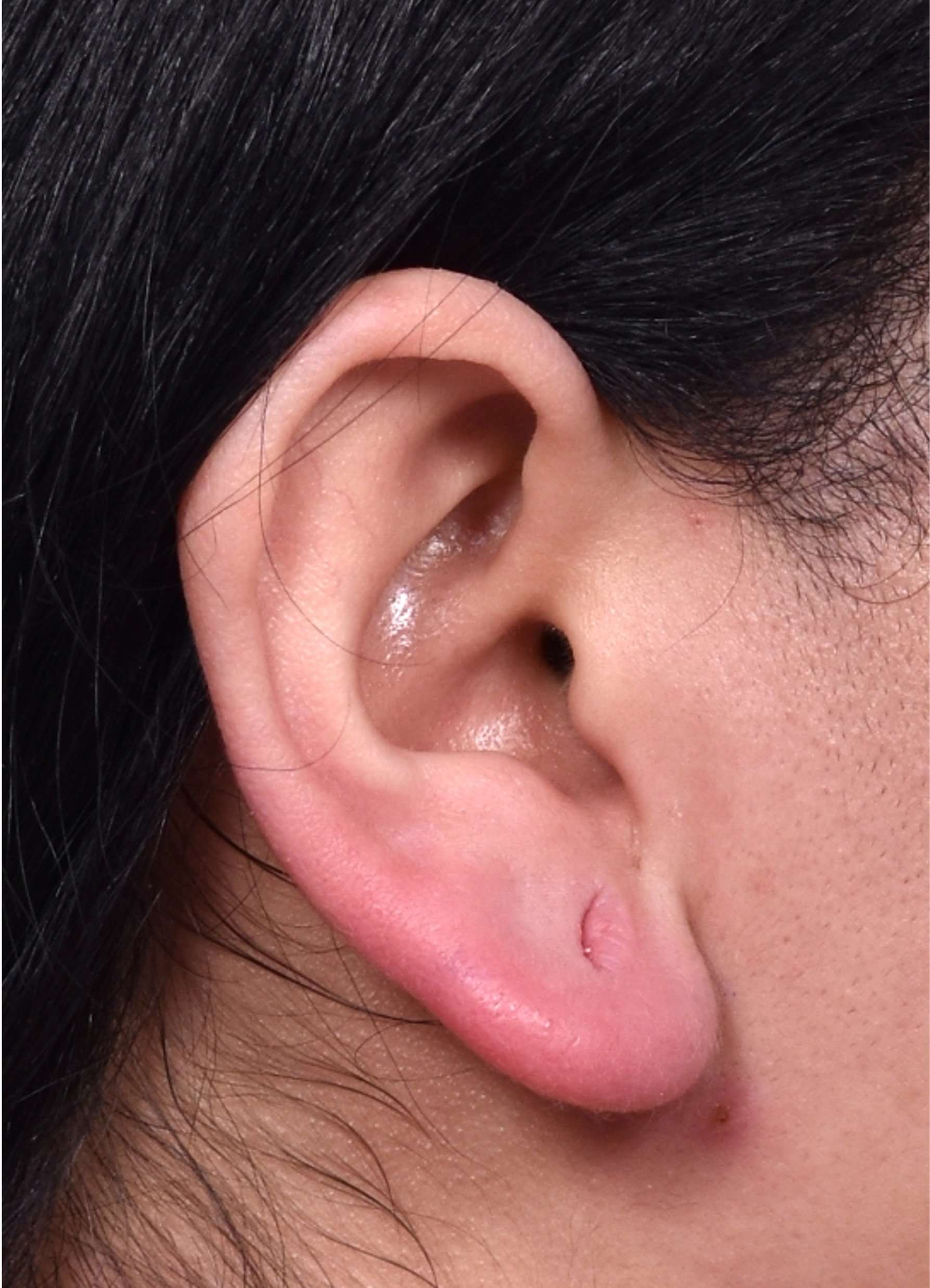 Gauged earlobe reduction repair