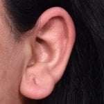 Gauged stretched earlobe repair