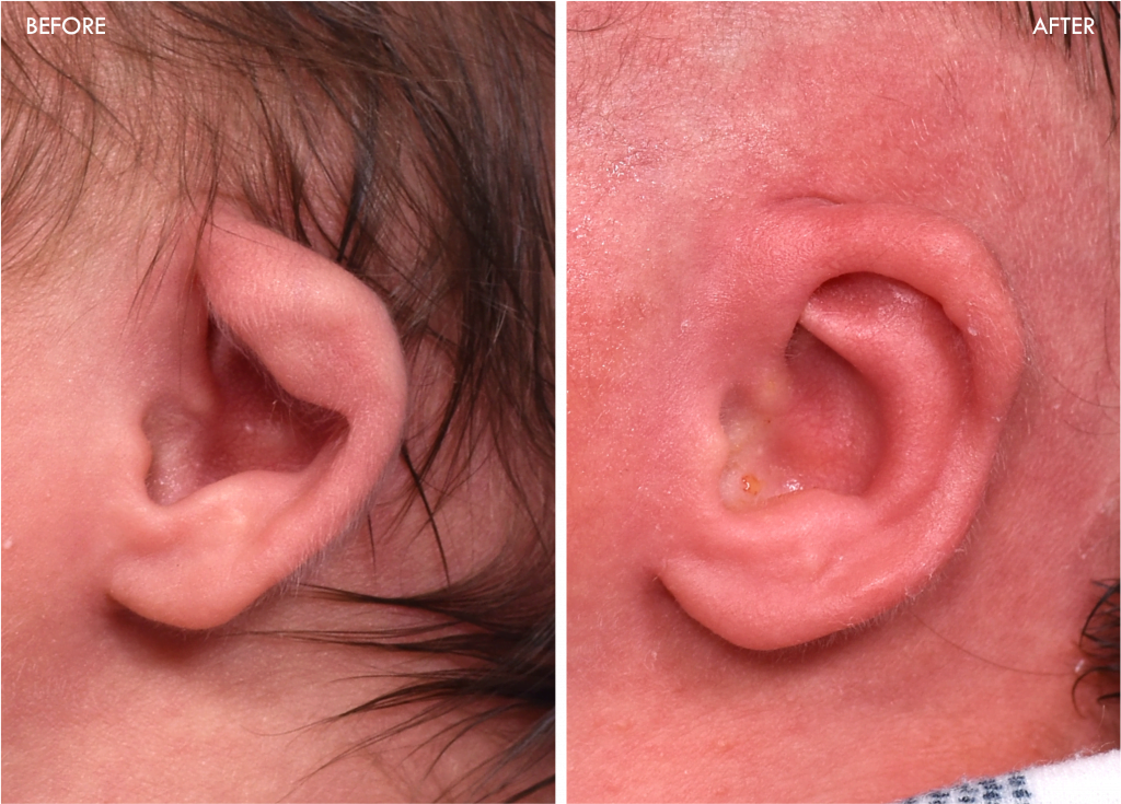 Earwell newborn ear correction Earwell newborn ear correction