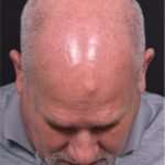 Forehead osteoma bump growth