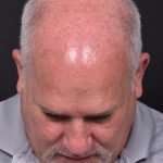 Forehead osteoma bump growth