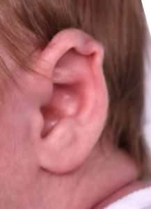 Earwell baby ear treatment Atlanta