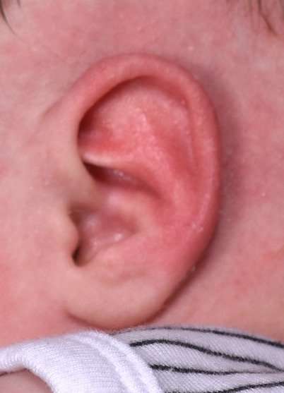 Earwell baby ear treatment Atlanta otoplasty