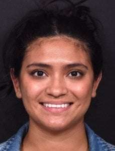 Otoplasty ear pinning surgery Atlanta