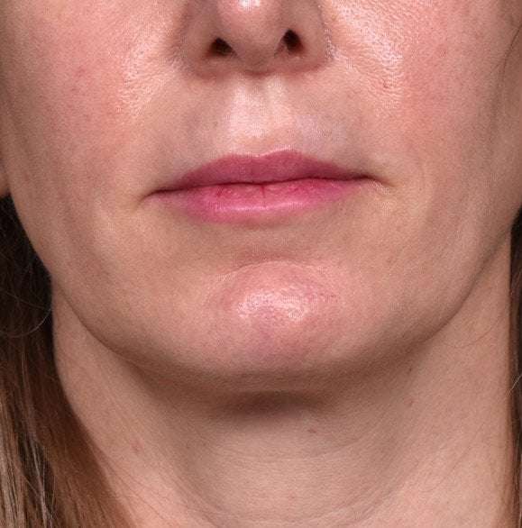 Lip filler Redensity Atlanta