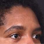 Forehead lipoma bump knot