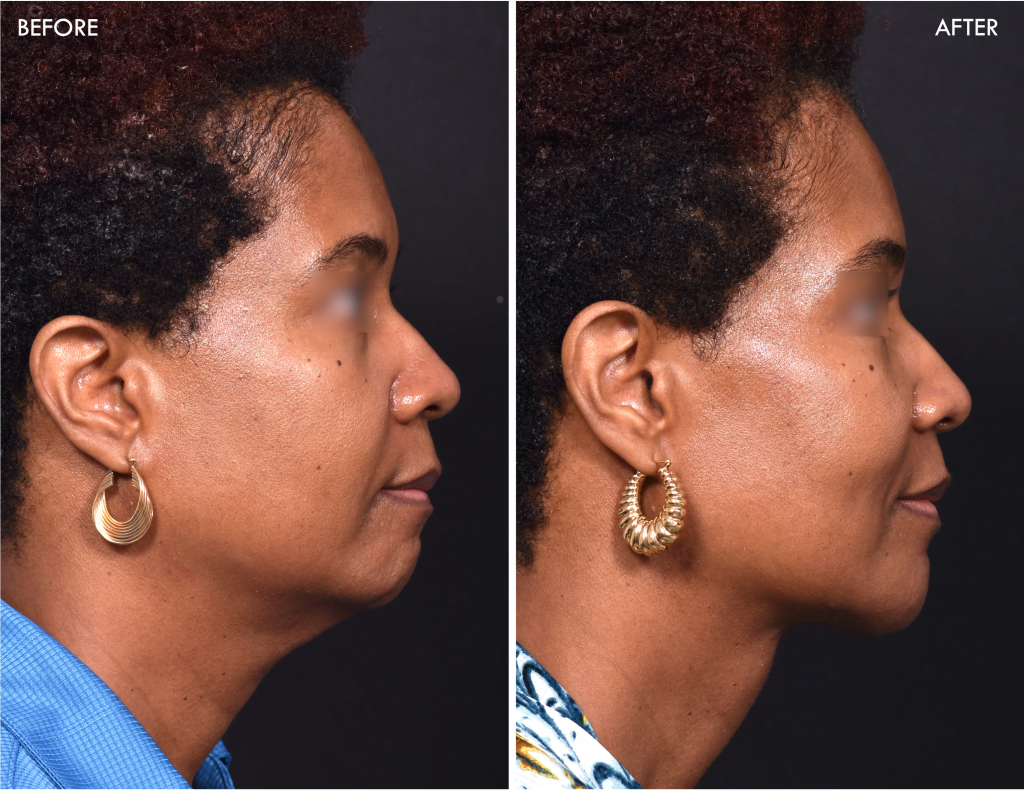 Chin implant contouring