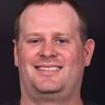 Forehead lump bump lipoma soft know surgery treatment