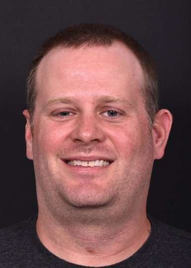 Forehead lump bump lipoma soft know surgery treatment