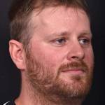 Forehead lipoma bump knot soft treatment