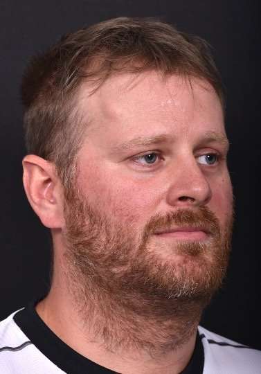 Forehead lipoma bump knot soft treatment