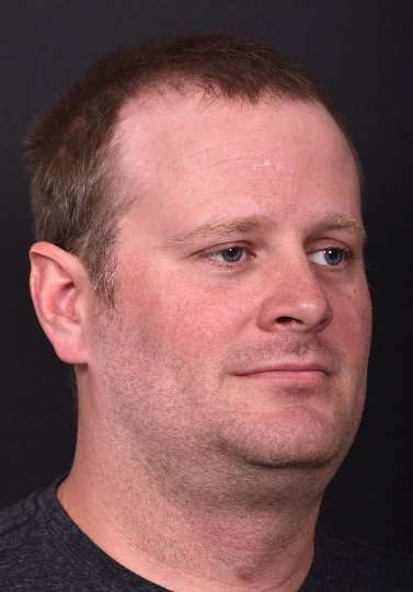 Forehead lipoma bump knot soft treatment