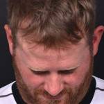 Forehead lipoma bump knot soft treatment