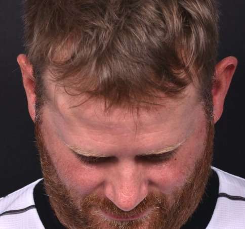 Forehead lipoma bump knot soft treatment