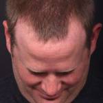 Forehead lipoma bump knot soft treatment