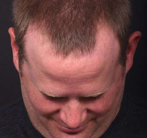 Forehead lipoma bump knot soft treatment