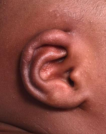 Earwell newborn ear correction Atlanta