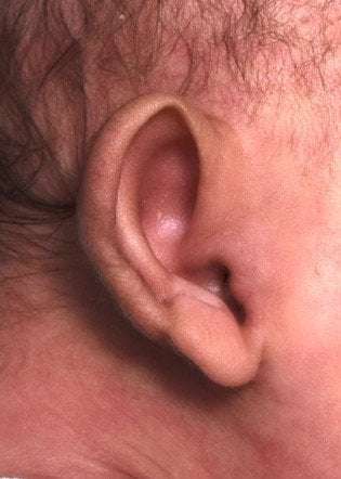 Earwell newborn ear correction shaping treatment