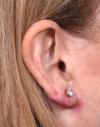 Earlobe reduction and piercing repair treatment