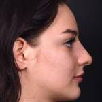 Nonsurgical or liquid rhinoplasty reshape nose without surgery
