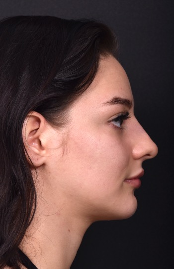 Nonsurgical or liquid rhinoplasty reshape nose without surgery