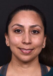 Lip lift Atlanta before and after bullhorn