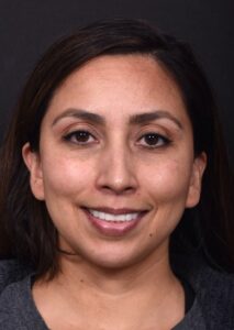 Lip lift Atlanta before and after bullhorn