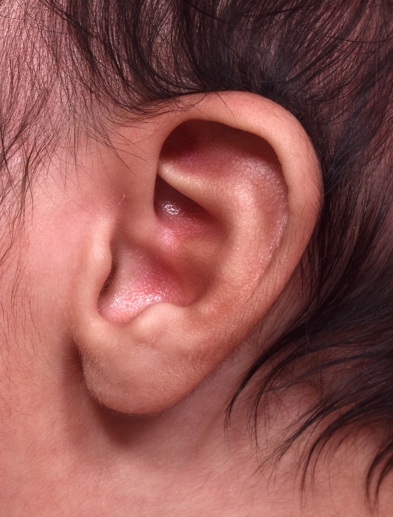 Earwell baby ear before and after Atlanta treatment