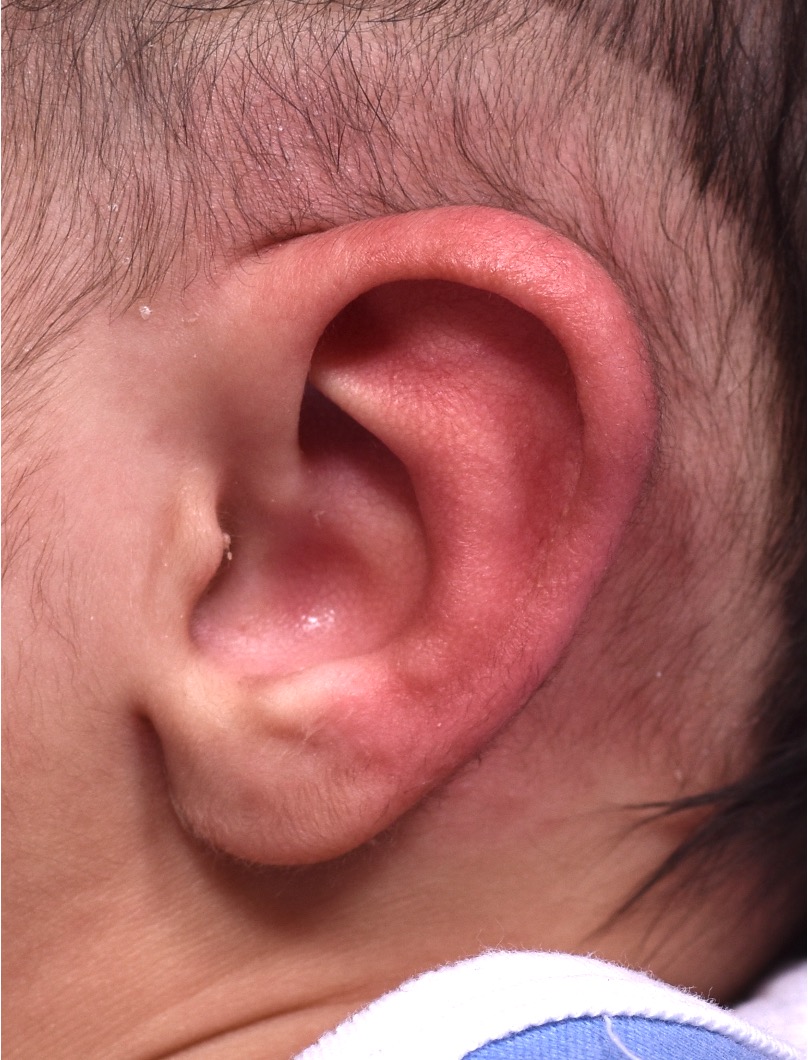 Earwell baby ear before and after Atlanta