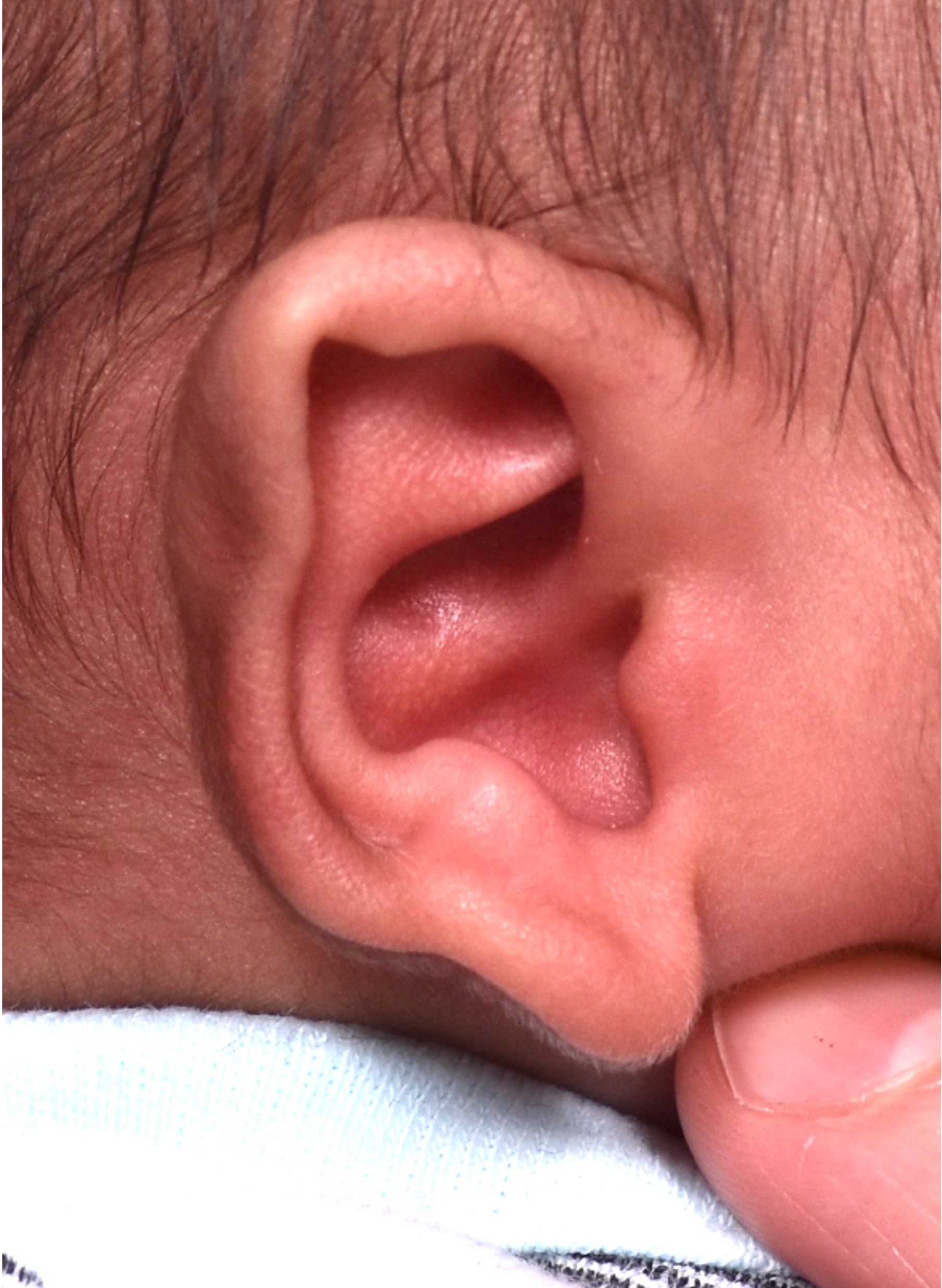 Newborn baby ear correction Atlanta before and after Earwell